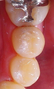 隣接面ひび割れによる虫歯１.jpg