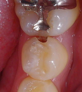 隣接面ひび割れによる虫歯２.jpg