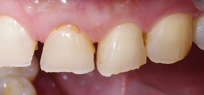 咬み合わせが原因で前歯が磨耗２.jpg