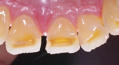 咬み合わせが原因で前歯が磨耗３.jpg