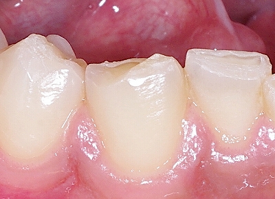咬み合わせによる前歯の磨耗２－下ー拡大.jpg