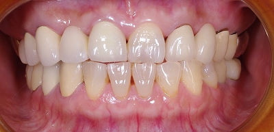 咬み合わせによる前歯の磨耗６－１.jpg