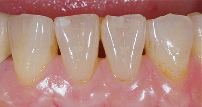 咬み合わせによる前歯の磨耗６－２.jpg