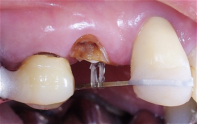 エクストルージョン上顎小臼歯１.jpg