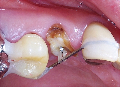 エクストルージョン上顎第一小臼歯２.jpg