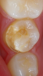 エナメル質形成不全第２小臼歯咬合面.jpg