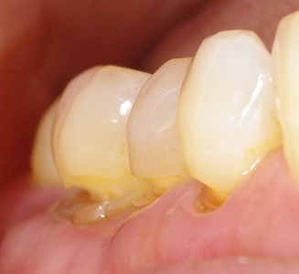 虫歯の治療 13年4月 あき歯科医院の医院ブログ