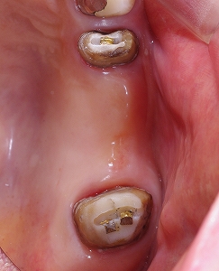 ブリッジ脱離をインプラントで修復６－３.jpg