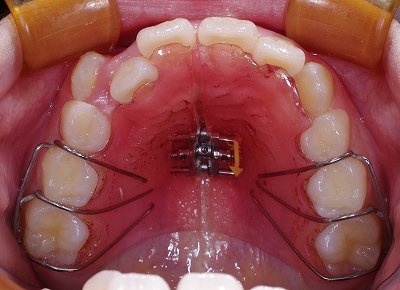 左上前歯が奥に入っているー上.jpg