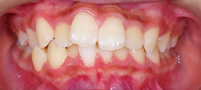 左上側切歯の叢生１.jpg