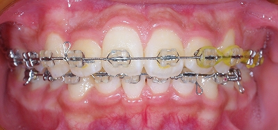 左上側切歯の叢生２.jpg