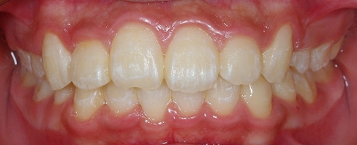 左上側切歯の叢生３.jpg
