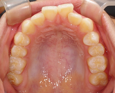 左上側切歯の叢生４.jpg
