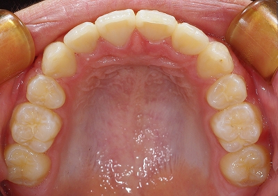 左上側切歯の叢生５.jpg