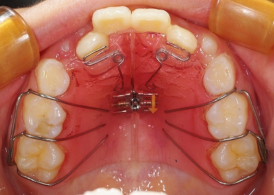 歯列弓拡大上.jpg