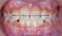 上の前歯のレべリング.jpg