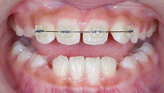 上の前歯のレべリングー２.jpg