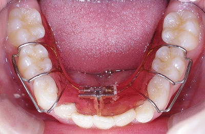 上下側切歯スペース不足術後下.jpg