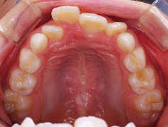上顎前歯叢生１.jpg