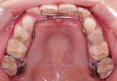 前歯かみ合わせ反対、下顎３.jpg