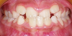 前歯のかみ合わせが反対、下顎が前に出ている１.jpg