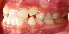 前歯のかみ合わせが反対、下顎が前に出ている２.jpg