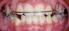 前歯のかみ合わせ反対、下顎７.jpg