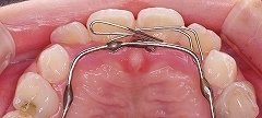 前歯のかみ合わせ反対下顎４.jpg