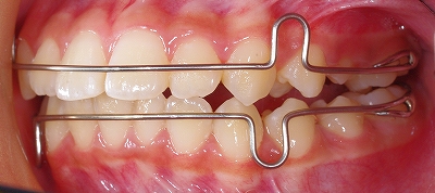 側方歯群の矯正右.jpg