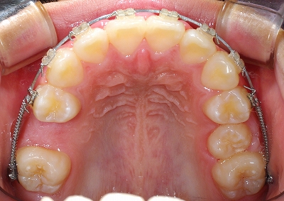 第二小臼歯スペース不足１－３.jpg