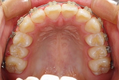 第二小臼歯スペース不足１－４.jpg