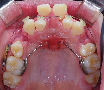 中切歯唇側転移１.jpg