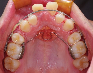 中切歯唇側転移２.jpg