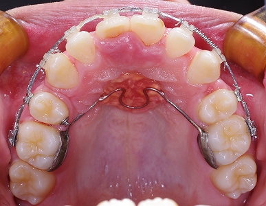 中切歯唇側転移３.jpg