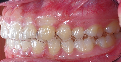 透明な矯正装置１３，８－２.jpg