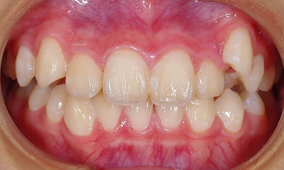 右上の八重歯１.jpg