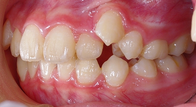 右上の八重歯２.jpg