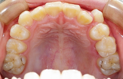 右上の八重歯３.jpg