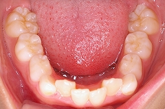 下顎前歯叢生１.jpg