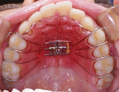 拡大床による咬合の変化２.jpg