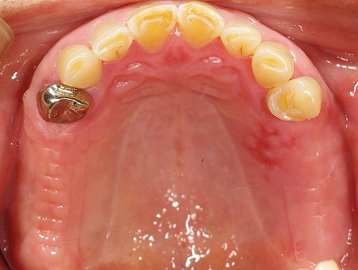 義歯による歯ぐきの圧迫１.jpg