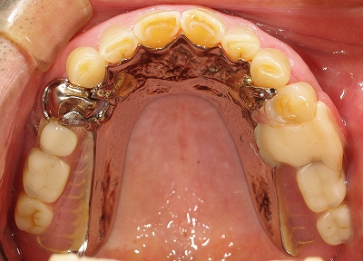 義歯による歯ぐきの圧迫２.jpg