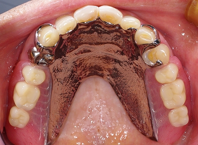 義歯による歯ぐきの圧迫３.jpg