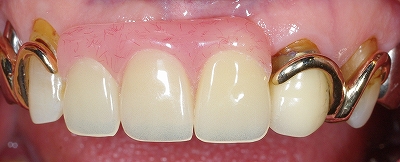 上顎前歯義歯１.jpg