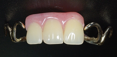 上顎前歯義歯２.jpg