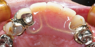上顎前歯義歯３.jpg