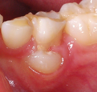 乳歯の下から永久歯.jpg