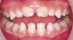 乳歯の前歯の先欠１.jpg
