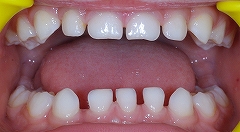乳歯先欠２.jpg