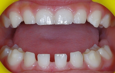 乳歯先欠前歯2本－２.jpg